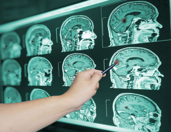 A doctor points to printouts from a brain scan to diagnose a traumatic brain injury.